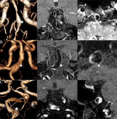 Comparisons between cross-section and long-axis-section in the quantification of aneurysmal wall enhancement of fusiform intracranial aneurysms in identifying aneurysmal symptoms